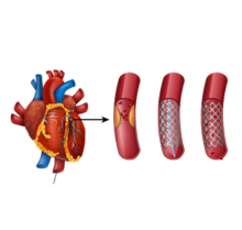 Angioplasty